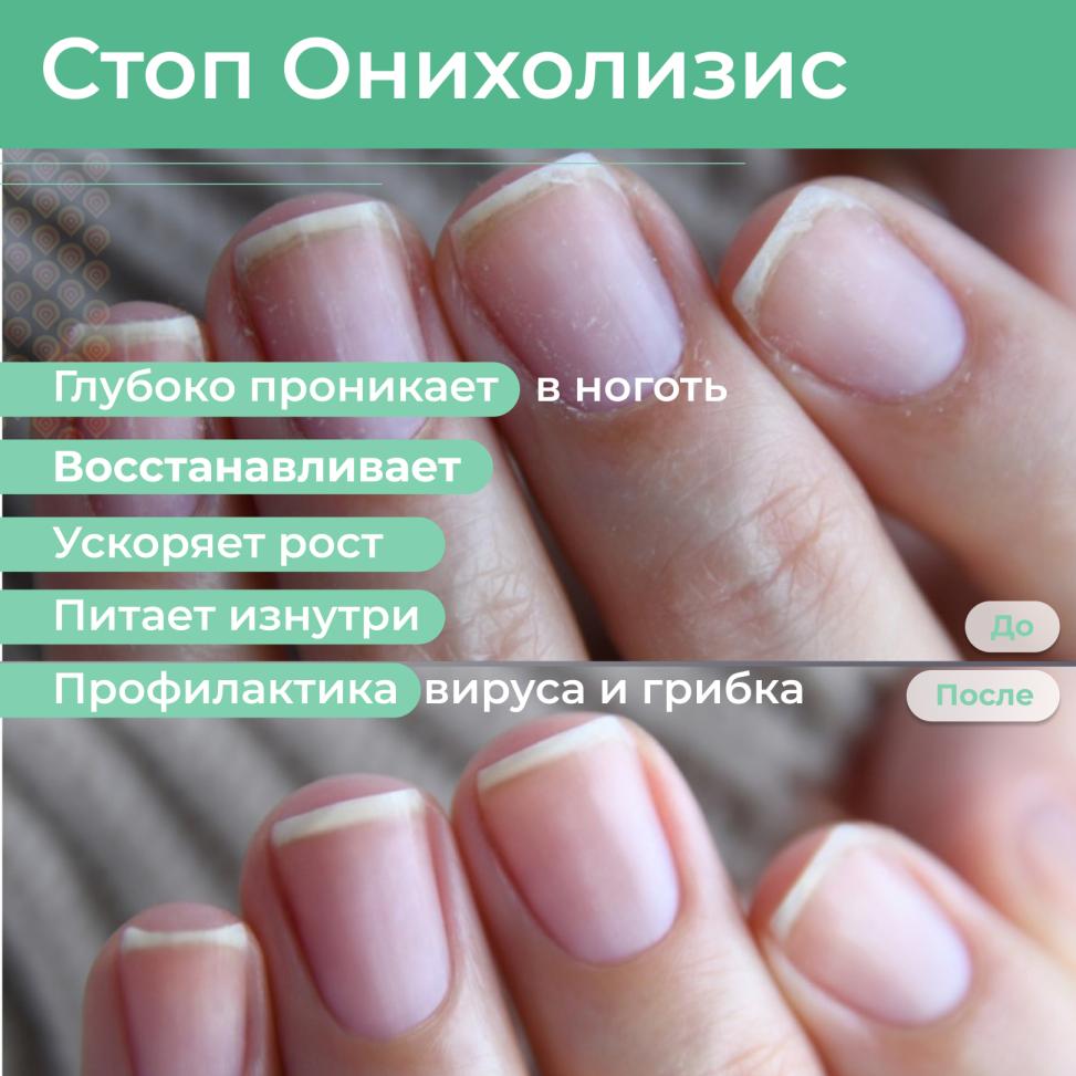 Сыворотка Стоп Онихолизис MASURA, 30 мл с пипеткой - превью